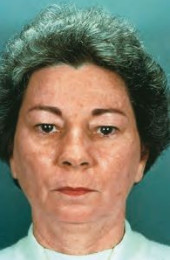 Efudix treatment Efudix