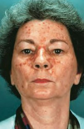 Efudix treatment Efudix