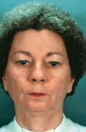 Efudix treatment Efudix