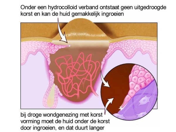 The mechanism of action of hydrocolloid dressings